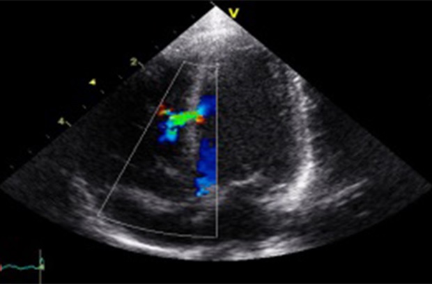 Cardiothoracic ultrasound image