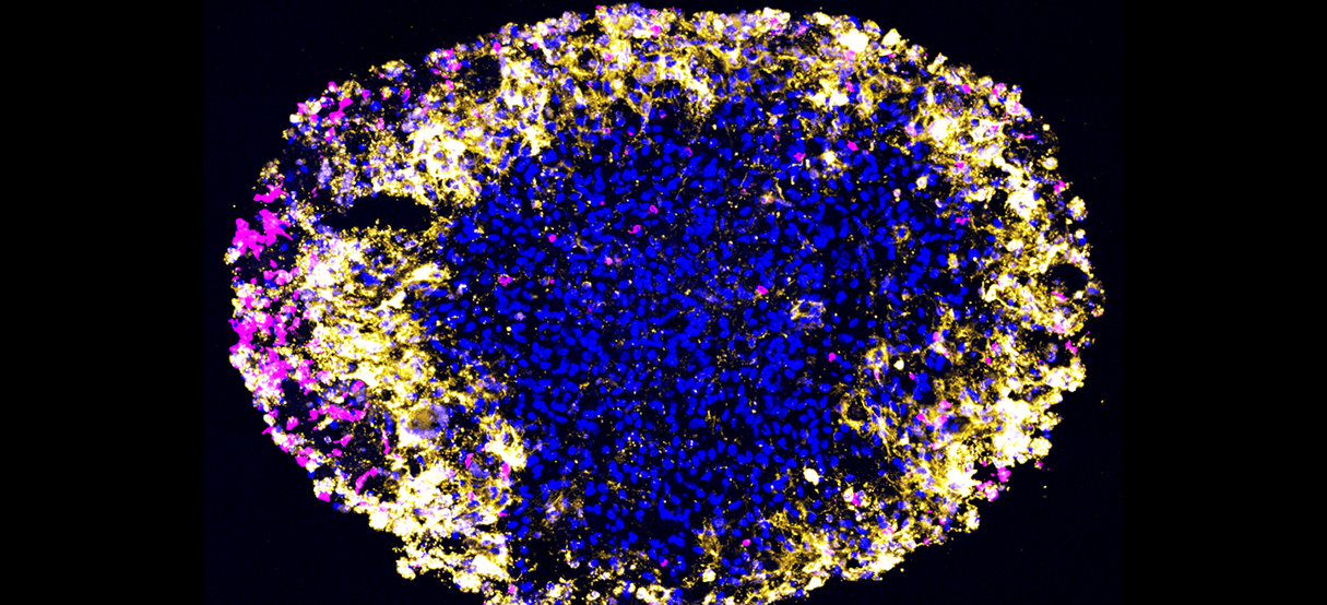 Patient-derived glioblastoma organoid treated with dual-target CAR-T cells.