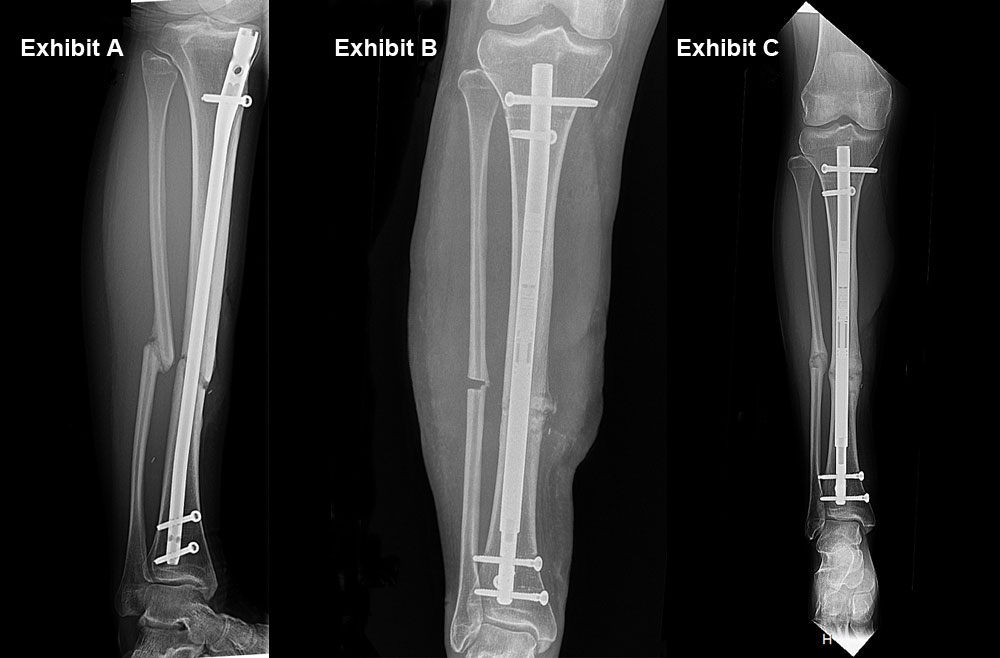 Patient with tibia nonunion. a X-ray from the pre-treatment period