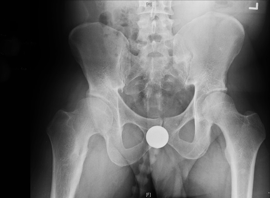 X-ray image of retrotorsinal femoral deformity of the hip