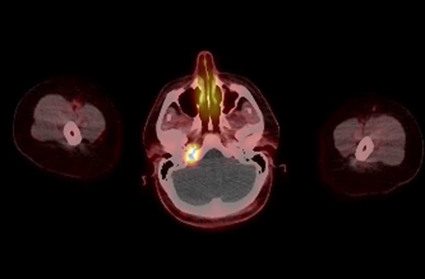 PET scan of the head