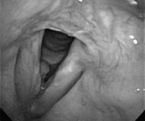 Photograph of vocal chords