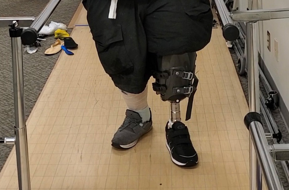 How I Don And Doff My Above Knee Prosthetic Leg 