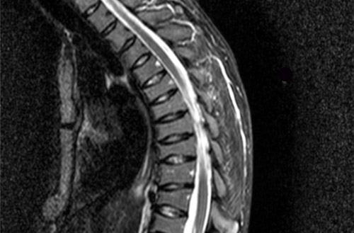 Sagittal T2-weighted images demonstrating multilevel vertebral compression fractures