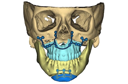Virtual surgical planning for surgeries to realign lower jaw and chin and for TMJ replacement