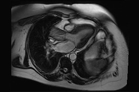 An MRI shows aortic valve stenosis in a woman with a bicuspid aortic valve.