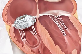 Crown-shaped EVOQUE transcatheter tricuspid valve replacement device in place looping the valvular tendinous chords.