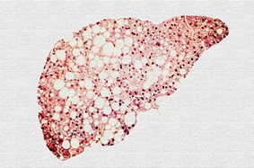liver with fat deposits