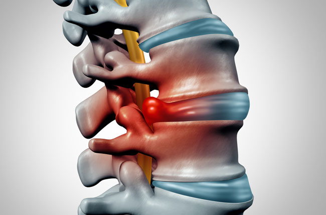 5 Signs of A Herniated Disc & How A Spine Specialist Can Help