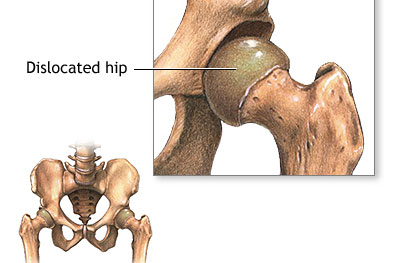 Hip Dysplasia – Symptoms and Causes