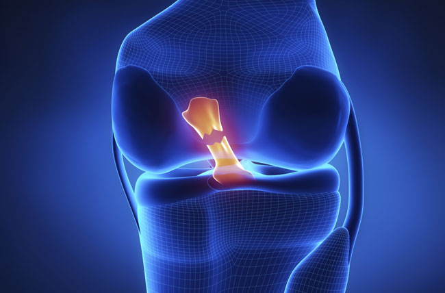 ACL Tear & Injury: Symptoms, Recovery, and Prevention