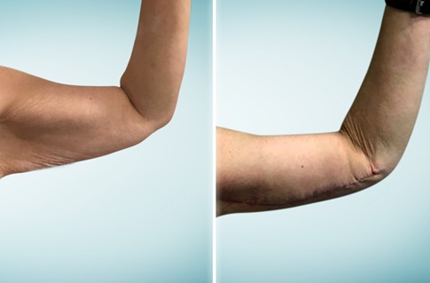 Arm lift, before and after