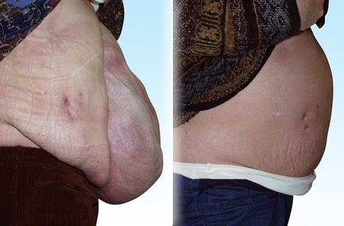 Before and after images of an abdominal wall reconstruction