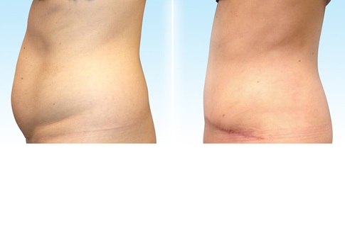 Before and after images of an abdominoplasty