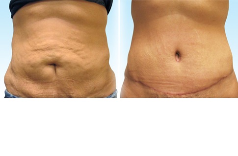Before and after images of an abdominoplasty