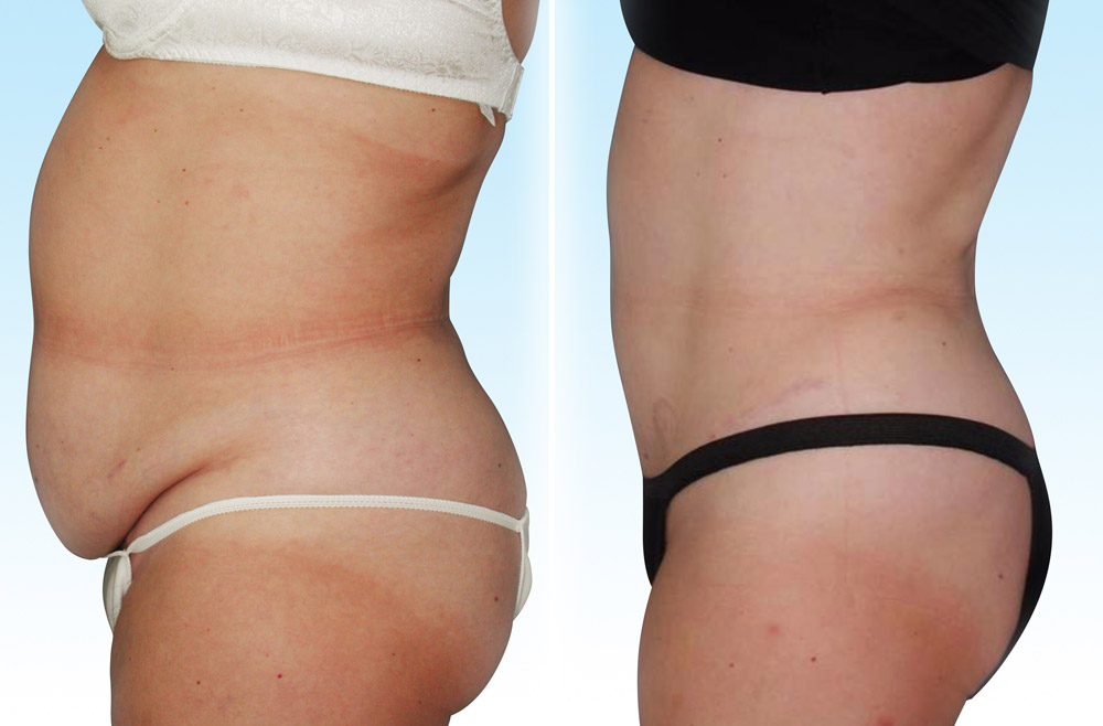 Tummy Tuck (Abdominoplasty) - Penn Medicine Cosmetic Services