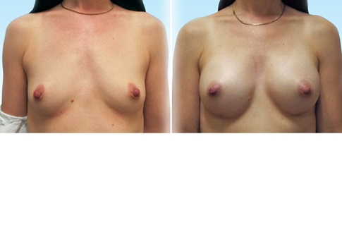 Before and after images of a breast augmentation