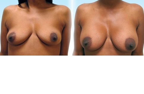 Before and after images of a breast augmentation
