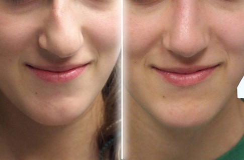 Before and after images of a nasal deformity repair