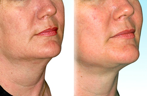Before and after images of a facelift