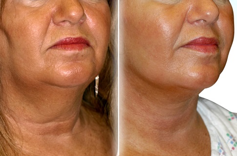 Before and after images of a facelift
