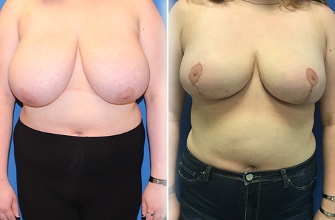 Breast Reduction Before and After Example 1
