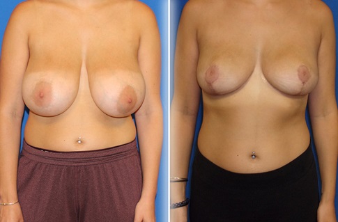 Breast Reduction Before and After Example 2
