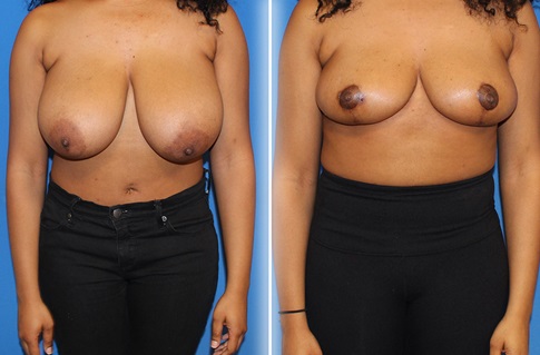 Breast Reduction Before and After Example 3