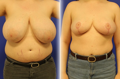 Breast Reduction Before and After Example 4
