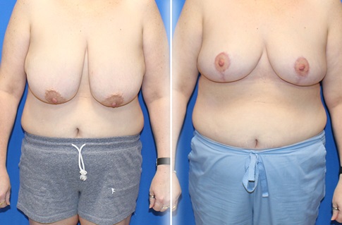Breast Reduction Before and After Example 6