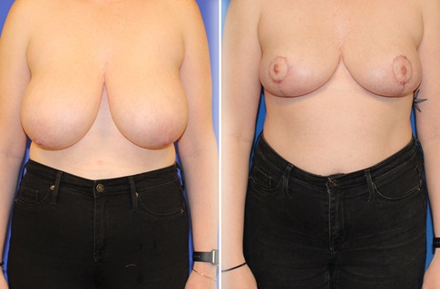 Breast Reduction Before and After Example 7