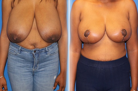 Breast Reduction Before and After Example 8