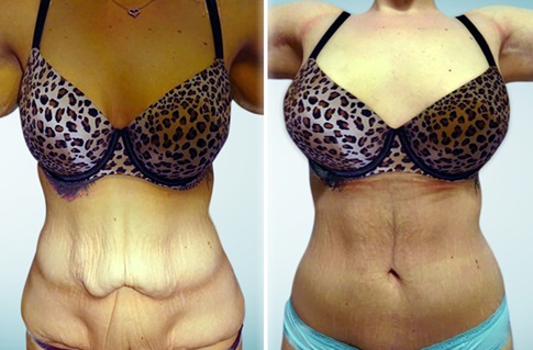 Tummy tuck, before and after