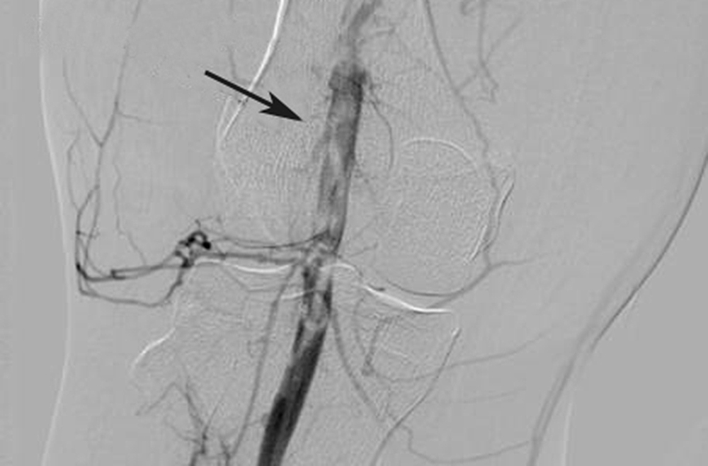 venogram venous occlusive disease