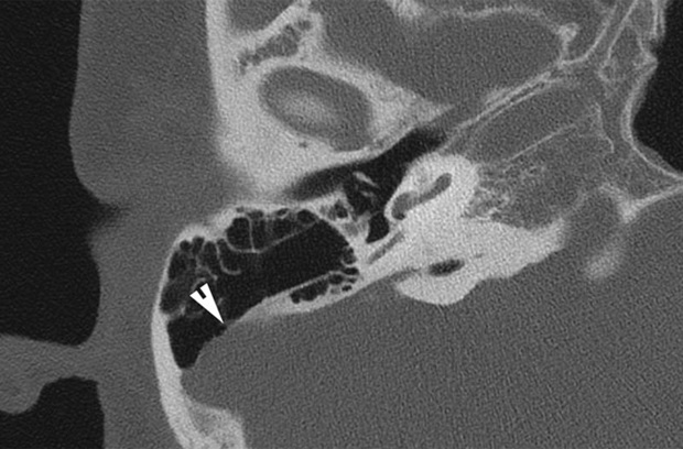 An axial CT scan demonstrating a broad dehiscence of the sigmoid sinus (white arrowhead)