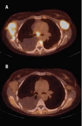 Image depicting a patient with lymphoma before and after CART therapy.