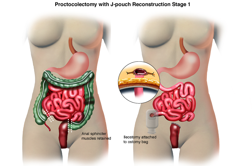 Total Proctocolectomy with J-pouch Reconstruction - Penn Medicine