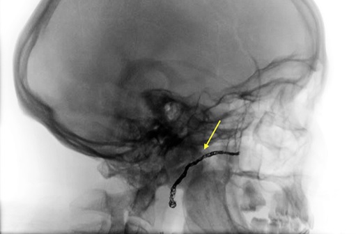 successful embolization on the internal maxillary artery medial to the ankylotic mass
