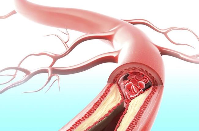 Deadly Obstruction Artery Model