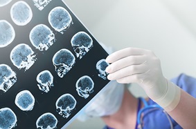 brain scan xray for epilepsy 