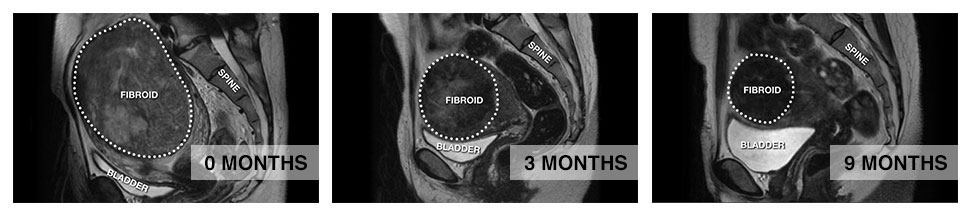 What Is Fibroid Expulsion? What You Need To Know