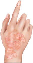 Hand with rash on it