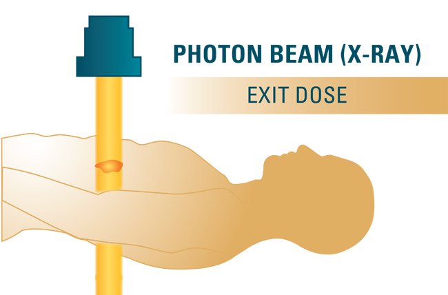 Breast Cancer How Proton Therapy Is Protecting Hearts