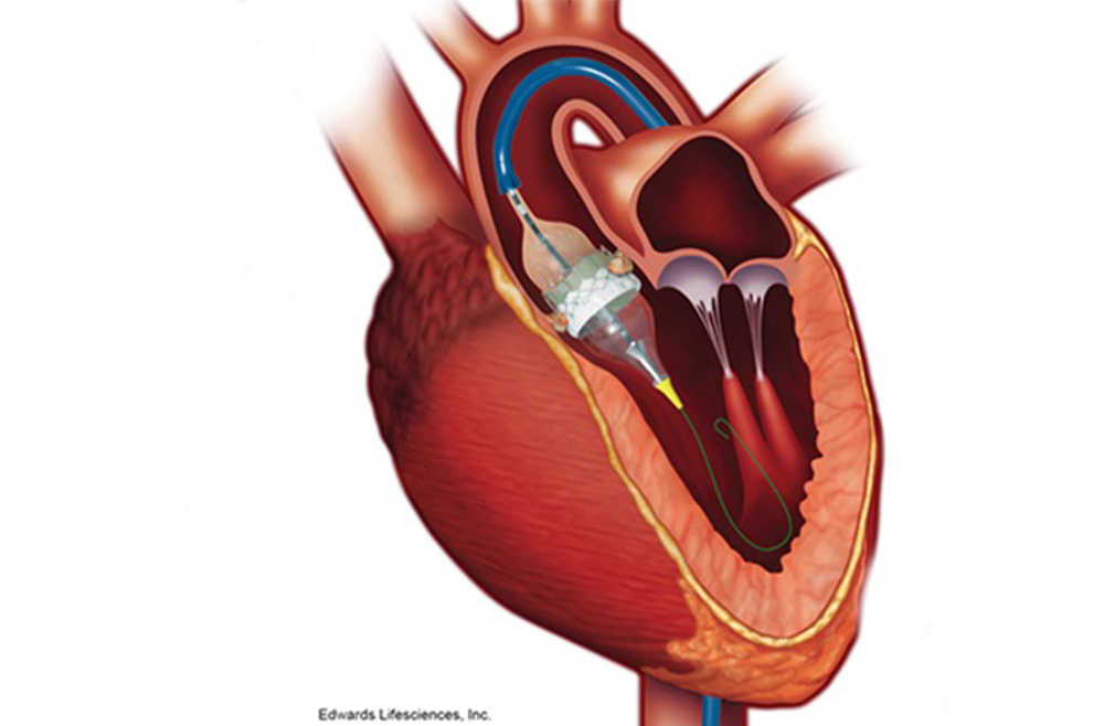 Through a Small Incision, a New Lease on Life - Penn Medicine