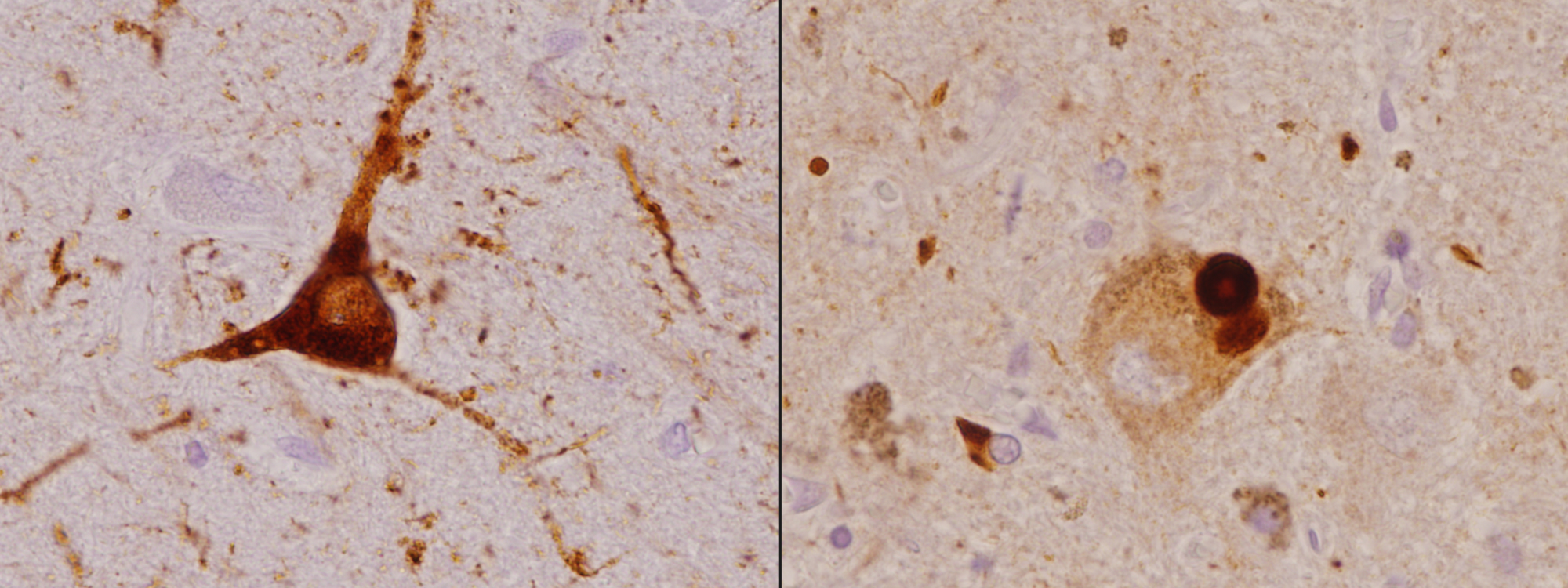 Evidence of Alzheimers in Patients with Lewy Body Tracks with Course of Dementia - Penn