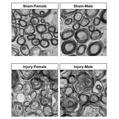 A graph of four panels, displaying two images of axons in female and male subject brains at the top, and two other images of damaged axons in male and female brains after injury at the bottom.
