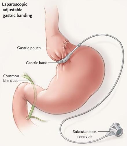 gastric-banding-surgery-the-lap-band-procedure-dekalb-medical