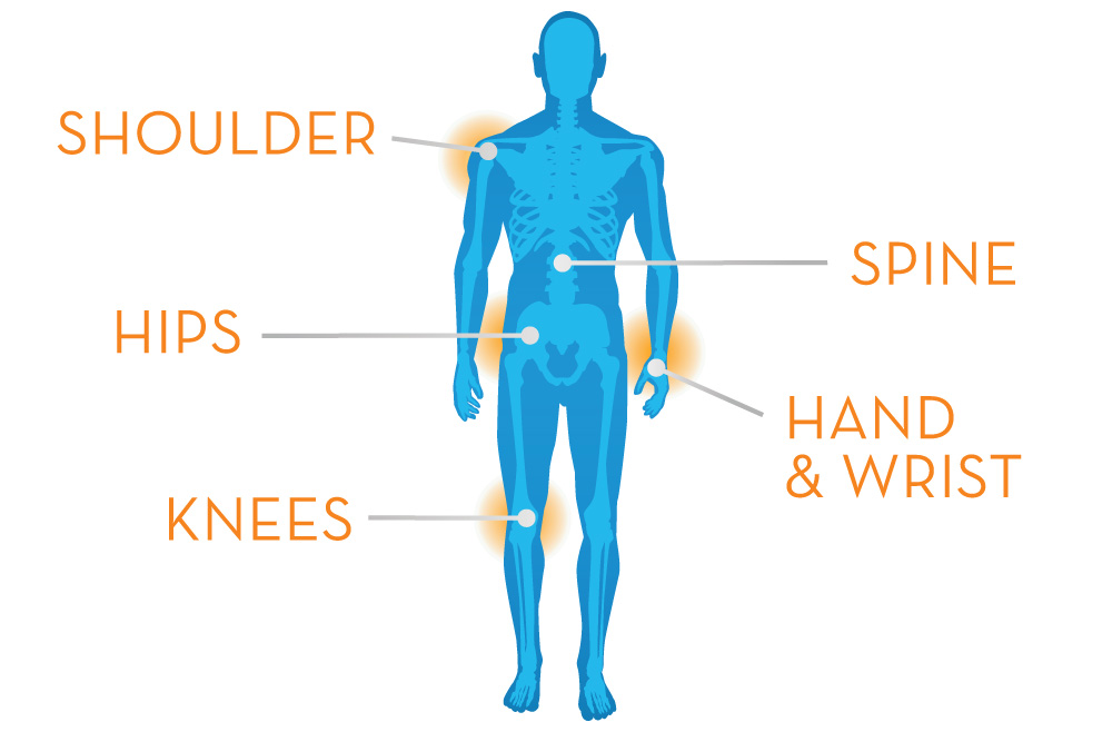 Arthritis – Penn Medicine